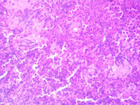 Granulomatous pneumonia with intra-lesional fungal hyphae